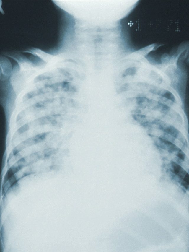 mycoplasma pneumoniae, walking pneumonia symptoms, walking pneumonia, mycoplasma pneumonia, pneumonia, walking pneumonia, walking pneumonia symptoms, signs of walking pneumonia, mild pneumonia, pneumonia symptoms, lung infection, what is walking pneumonia, walking pneumonia treatment, difference between pneumonia and walking pneumonia, contagious lung infections, fatigue and cough, mild cough won’t go away, hidden symptoms of pneumonia, understanding walking pneumonia, health risks of mild pneumonia, recognizing walking pneumonia, pneumonia diagnosis, early symptoms of pneumonia, cough and fatigue causes, respiratory infections, common lung infections, infections with mild symptoms, pneumonia vs cold, signs of lung infection, subtle pneumonia signs, respiratory health, identifying walking pneumonia, early diagnosis of pneumonia, cough and infection, pneumonia in adults, is walking pneumonia serious, caring for respiratory health, unexpected pneumonia diagnosis, health tips for pneumonia, mild respiratory infections, pneumonia in crowded places, pneumonia spread, silent lung infections, preventive care for pneumonia, how to treat pneumonia, avoiding lung infections, persistent cough,